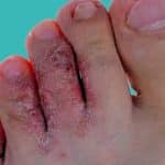 Athletes foot: Causes, symptoms and treatments
