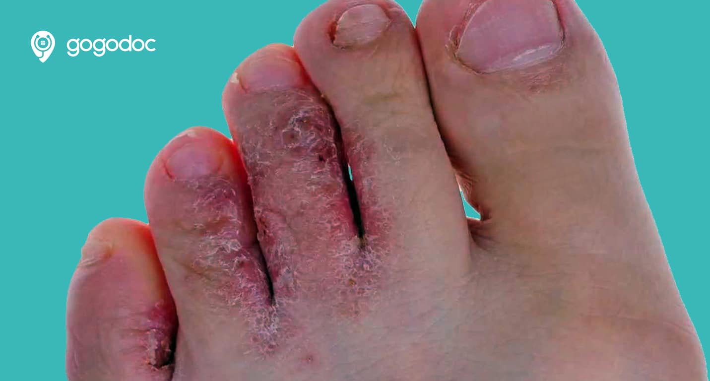 Athletes foot Causes, symptoms and treatments General Practice
