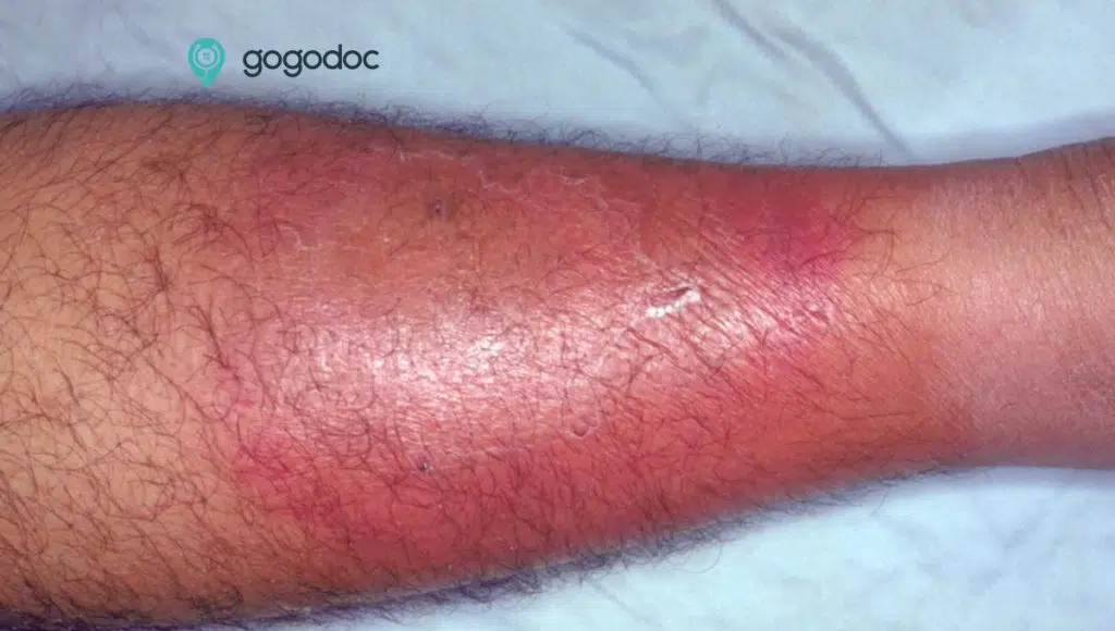 Cellulitis: Causes, Symptoms and Treatments
