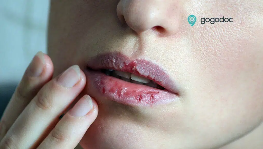 Chapped lips: Causes, Symptoms and Treatments