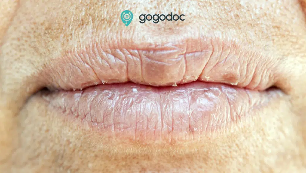 Dry lips: Causes, Symptoms and Treatments