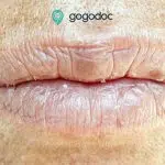 Dry lips: Causes, Symptoms and Treatments