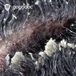 Dandruff: Causes, Symptoms and Treatments