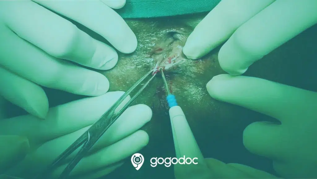 Anal Fissure surgery