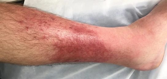 Read more about the article Cellulitis:Causes, Symptoms and Treatments