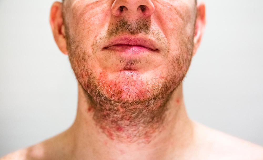 Read more about the article Folliculitis