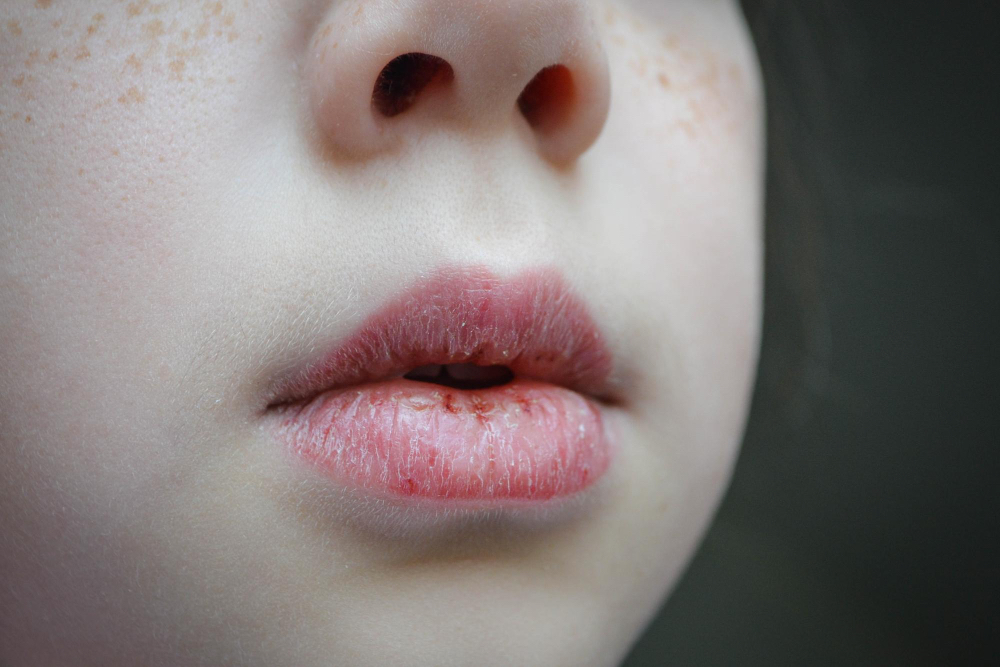 Read more about the article Chapped lips: Causes, Symptoms and Treatments